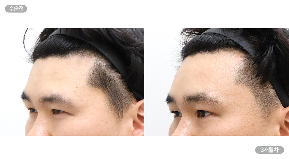 Before 2 Side