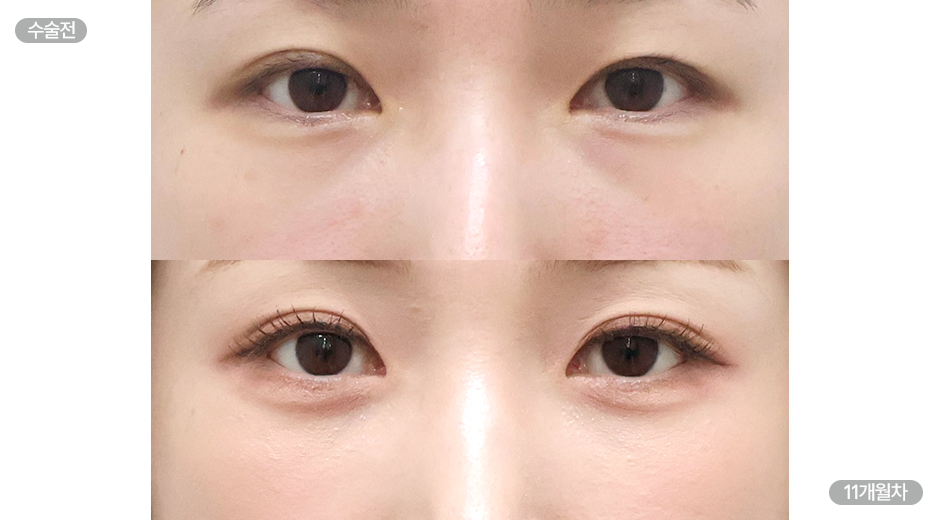 Before 8 Front
