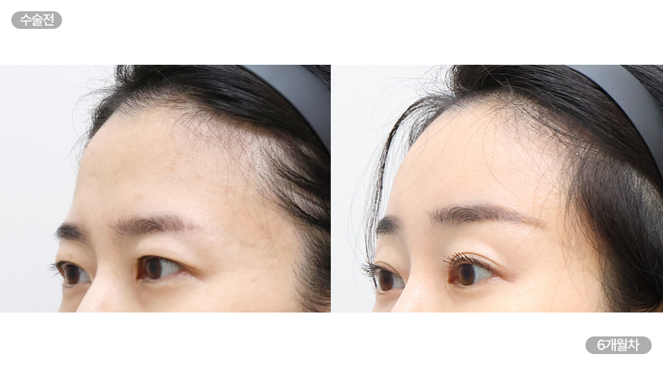 Before 3 Side
