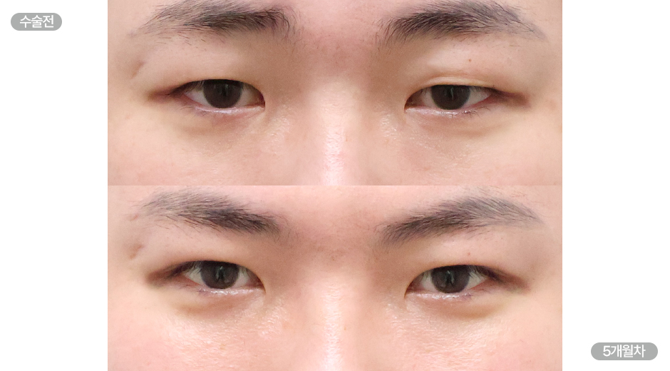 Before 2 Front