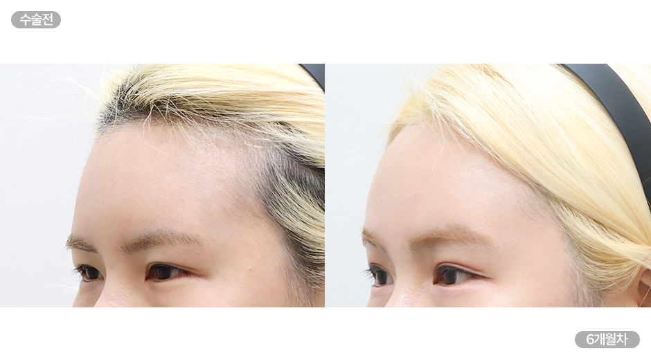 Before 5 Side