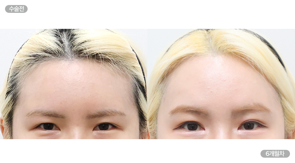 Before 5 Front
