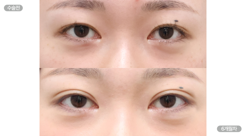 Before 8 Front